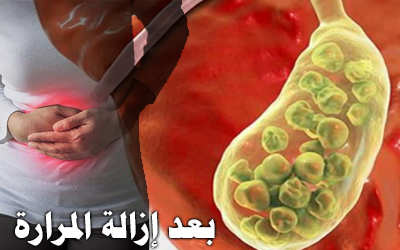  Post-cholecystectomy diet نظام بعد ازالة المرارة